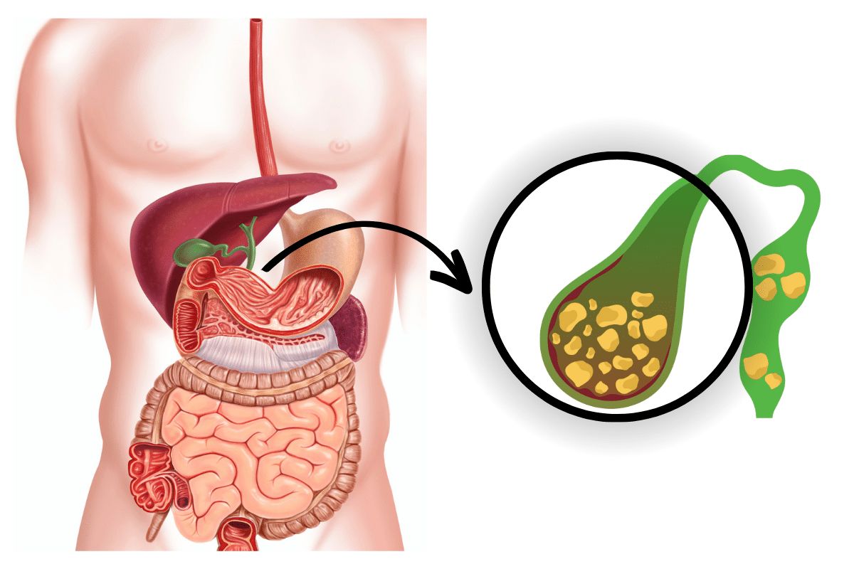 Robotic vs Laparoscopic Weight Loss Surgery